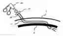 Fig. 01 - Transverse surgical tunneling
