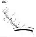 Fig. 02 - Transverse surgical tunneling