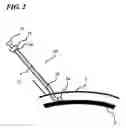 Fig. 03 - Transverse surgical tunneling
