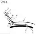 Fig. 04 - Transverse surgical tunneling