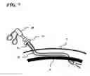 Fig. 08 - Transverse surgical tunneling