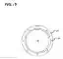 Fig. 11 - Transverse surgical tunneling