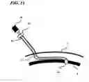 Fig. 12 - Transverse surgical tunneling