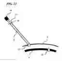 Fig. 13 - Transverse surgical tunneling