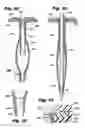 Fig. 13 - Devices for and methods of performing minimally-invasive surgical procedures through a single incision