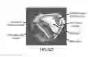 Fig. 07 - Automated methods and systems for vascular plaque detection and analysis