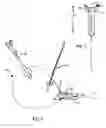 Fig. 02 - Urethral catheterless radical prostatectomy