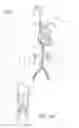 Fig. 02 - Method of capturing and macerating particles in a blood vessel