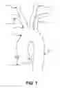 Fig. 02 - Intravascular blood filter