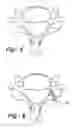 Fig. 04 - Laminoplasty apparatus and methods