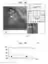 Fig. 12 - Automatic correction and utilization of a vascular roadmap comprising a tool