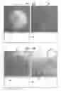 Fig. 16 - Automatic correction and utilization of a vascular roadmap comprising a tool