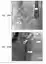 Fig. 25 - Automatic correction and utilization of a vascular roadmap comprising a tool