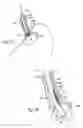 Fig. 09 - SURGICAL INSTRUMENTS AND TECHNIQUES FOR TREATING GASTRO-ESOPHAGEAL REFLUX DISEASE