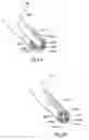 Fig. 11 - SURGICAL INSTRUMENTS AND TECHNIQUES FOR TREATING GASTRO-ESOPHAGEAL REFLUX DISEASE