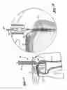 Fig. 02 - Knotless suture anchoring device having deforming section to accommodate sutures of various diameters
