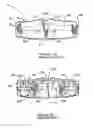 Fig. 03 - Orthodontic appliance