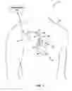 Fig. 02 - Detecting worsening heart failure based on fluid accumulation with respiratory confirmation