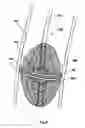 Fig. 07 - Devices and systems for valve removal