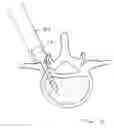 Fig. 08 - Screw Sheath for Minimally Invasive Spinal Surgery and Method Relating Thereto
