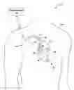 Fig. 01 - Pacing therapy adjustment based on ventriculo-atrial delay