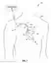 Fig. 02 - Pacing therapy adjustment based on ventriculo-atrial delay