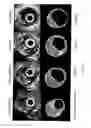 Fig. 13 - Bioabsorbable stent that modulates plaque geometric morphology and chemical composition