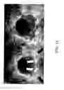 Fig. 15 - Bioabsorbable stent that modulates plaque geometric morphology and chemical composition