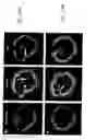 Fig. 16 - Bioabsorbable stent that modulates plaque geometric morphology and chemical composition