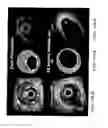 Fig. 19 - Bioabsorbable stent that modulates plaque geometric morphology and chemical composition