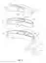 Fig. 03 - Implant with nested members and methods of use
