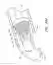 Fig. 32 - Devices for cleaning endotracheal tubes