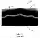 Fig. 02 - EMBEDDED STRESS ELEMENTS ON SURFACE THIN DIRECT SILICON BOND SUBSTRATES