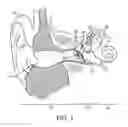 Fig. 02 - Hearing system having improved high frequency response
