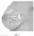 Fig. 02 - Brachytherapy device having an alignment and seal adaptor