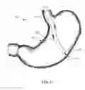 Fig. 07 - Expandable port for accessing a bodily opening