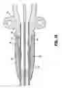 Fig. 16 - Catheter system with attachable catheter hub