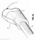 Fig. 33 - Catheter system with attachable catheter hub