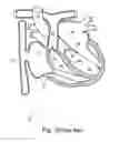 Fig. 02 - Cardiac valve leaflet augmentation