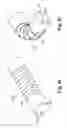 Fig. 45 - METHODS AND DEVICES FOR OCCLUSION OF AN ATRIAL APPENDAGE
