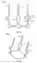 Fig. 06 - Two-stage collapsible/expandable prosthetic heart valves and anchoring systems