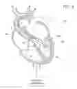 Fig. 07 - Guidable intravascular blood pump and related methods
