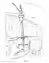Fig. 07 - Method for percutaneous lateral access to the left ventricle for treatment of mitral insufficiency by papillary muscle alignment