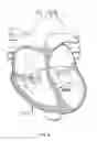 Fig. 09 - Method for percutaneous lateral access to the left ventricle for treatment of mitral insufficiency by papillary muscle alignment