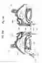 Fig. 09 - Devices, systems and methods for diagnosing and treating sinusitis and other disorders of the ears, nose and/or throat