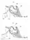 Fig. 35 - Devices, systems and methods for diagnosing and treating sinusitis and other disorders of the ears, nose and/or throat