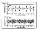 Fig. 03 - Respiratory signal detection and time domain signal processing method and system