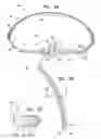 Fig. 03 - Actively-engageable movement-restriction mechanism for use with an annuloplasty structure