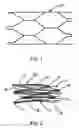 Fig. 02 - Intraluminal stent graft