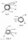 Fig. 04 - Intraluminal stent graft